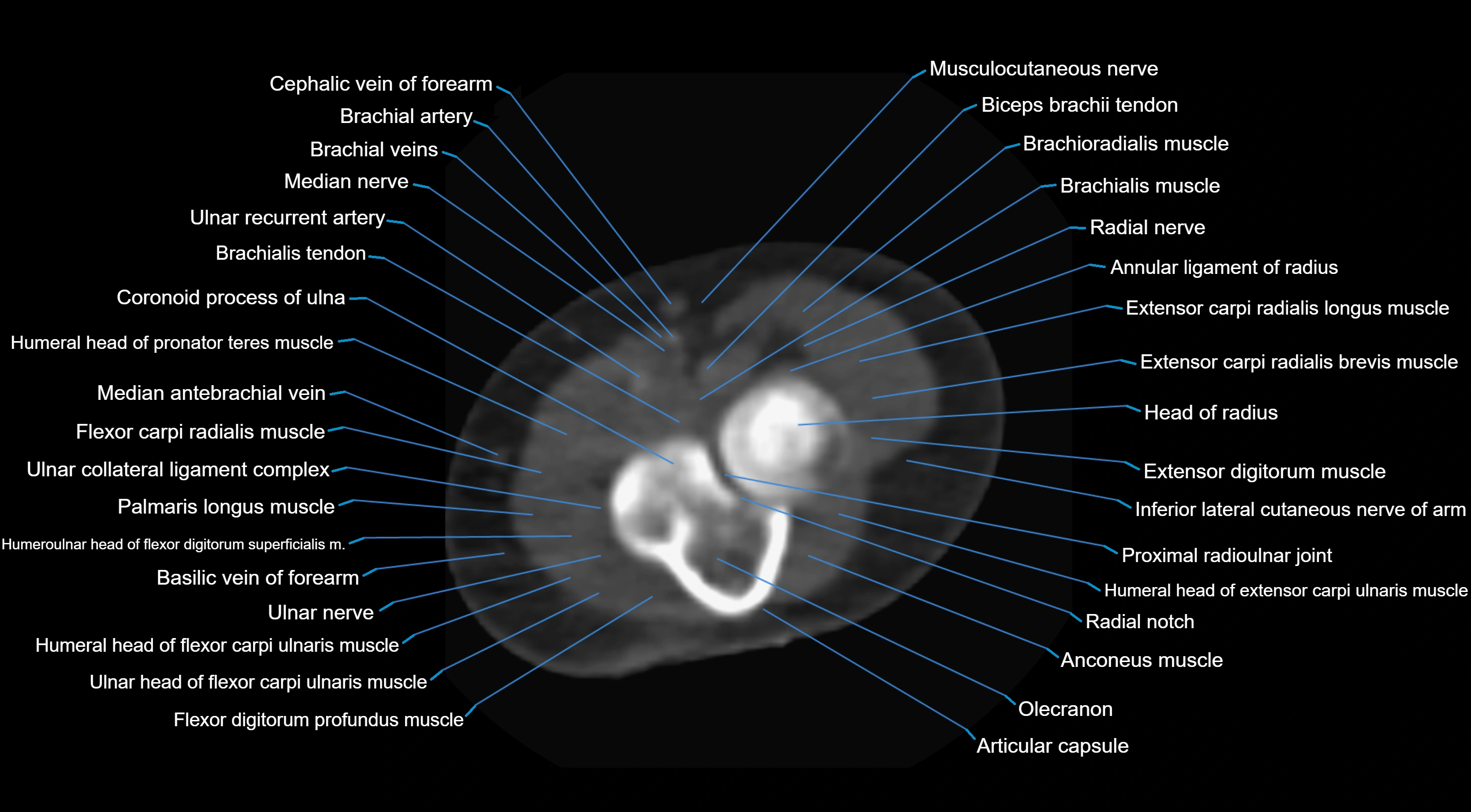 CT elbow axial  cross sectional anatomy labelled  radiology image -00030.webp
